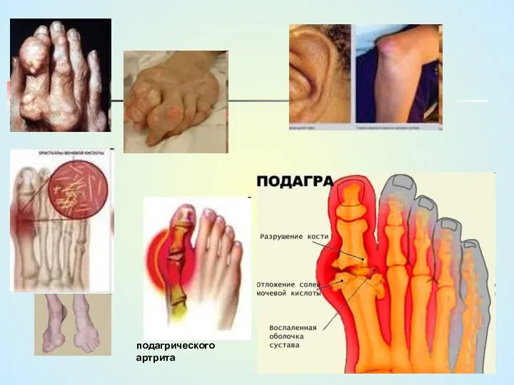 подагрического артрита