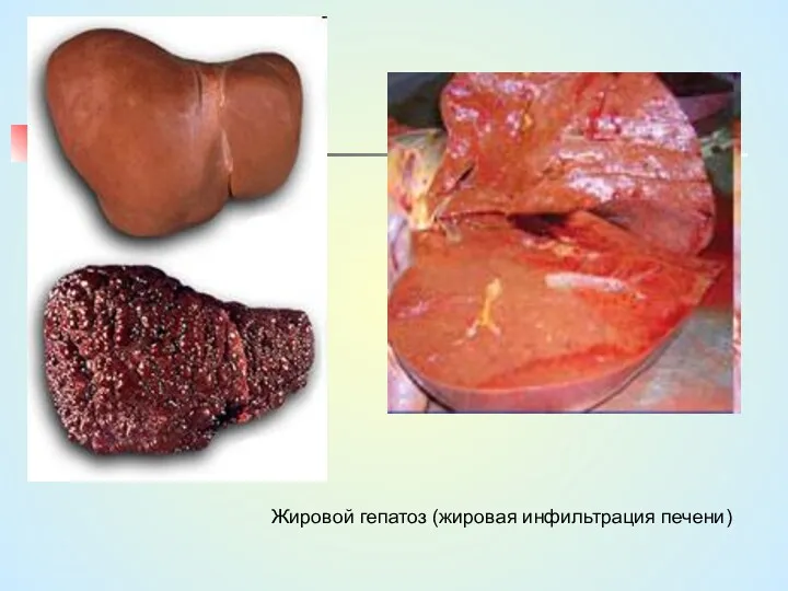 Жировой гепатоз (жировая инфильтрация печени)