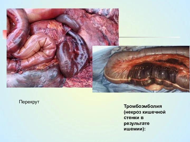 Перекрут Тромбоэмболия(некроз кишечной стенки в результате ишемии):
