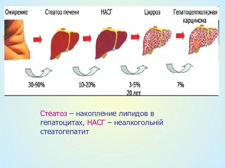 Стеатоз – накопление липидов в гепатоцитах, НАСГ – неалкогольній стеатогепатит