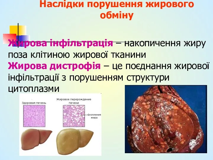 Наслідки порушення жирового обміну Жирова інфільтрація – накопичення жиру поза