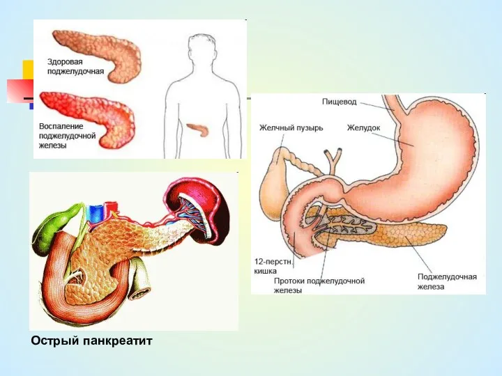 Острый панкреатит