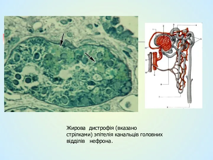 Жирова дистрофія (вказано стрілками) эпітелія канальців головних відділів нефрона.