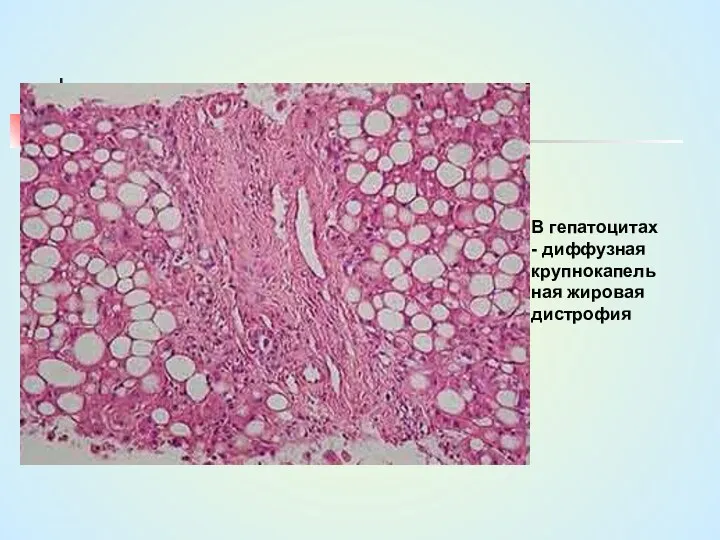 В гепатоцитах - диффузная крупнокапельная жировая дистрофия