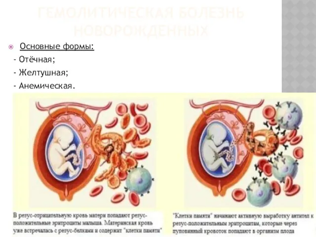 ГЕМОЛИТИЧЕСКАЯ БОЛЕЗНЬ НОВОРОЖДЕННЫХ Основные формы: - Отёчная; - Желтушная; - Анемическая.