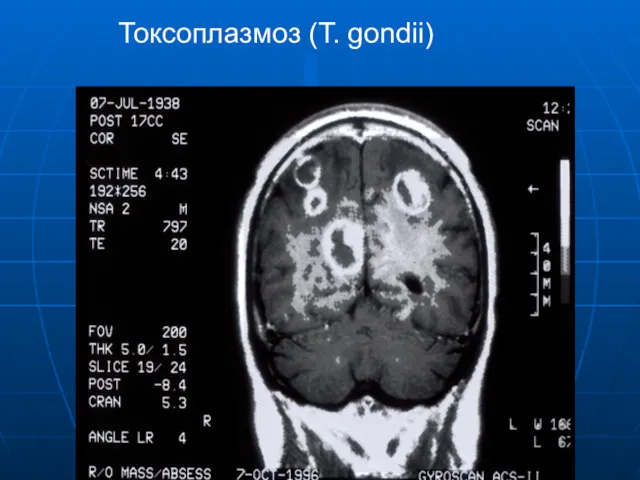 Токсоплазмоз (Т. gondii)