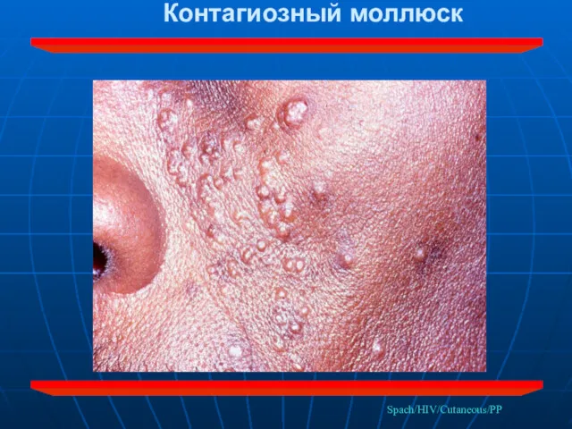 Spach/HIV/Cutaneous/PP Контагиозный моллюск