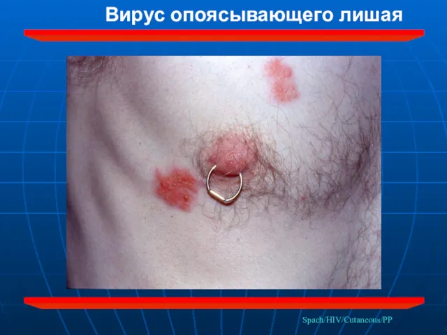 Spach/HIV/Cutaneous/PP Вирус опоясывающего лишая