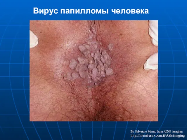 By Salvatore Marra, from AIDS imaging http://members.xoom.it/Aidsimaging Вирус папилломы человека