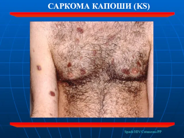 Spach/HIV/Cutaneous/PP САРКОМА КАПОШИ (KS)