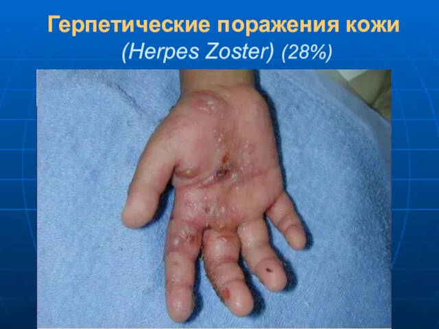 Герпетические поражения кожи (Herpes Zoster) (28%)