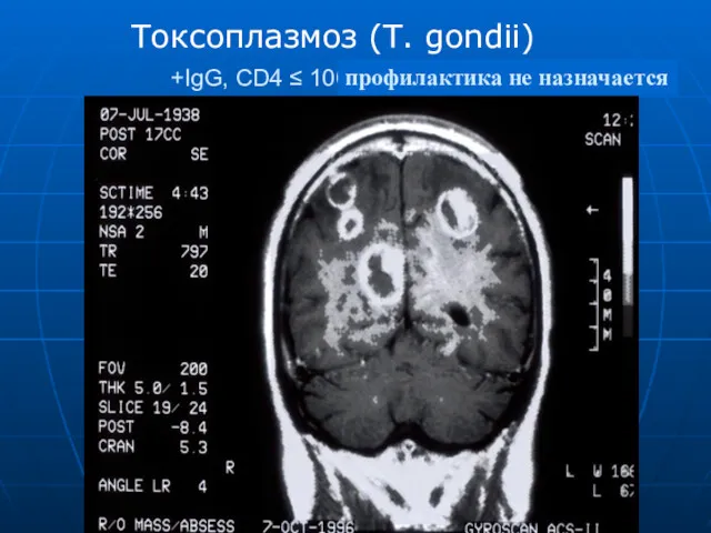 +IgG, CD4 ≤ 100, No prophylaxis given Токсоплазмоз (Т. gondii) профилактика не назначается