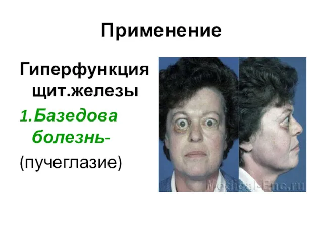 Применение Гиперфункция щит.железы 1.Базедова болезнь- (пучеглазие)