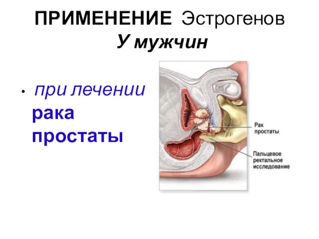 ПРИМЕНЕНИЕ Эстрогенов У мужчин при лечении рака простаты