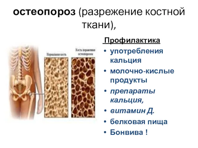 остеопороз (разрежение костной ткани), Профилактика употребления кальция молочно-кислые продукты препараты