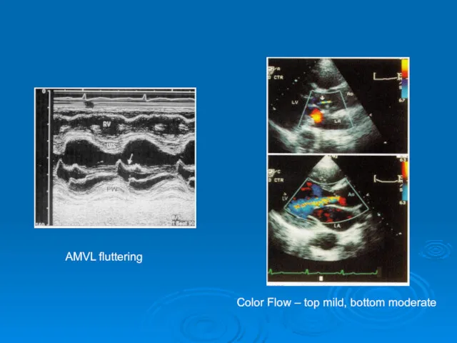 AMVL fluttering Color Flow – top mild, bottom moderate