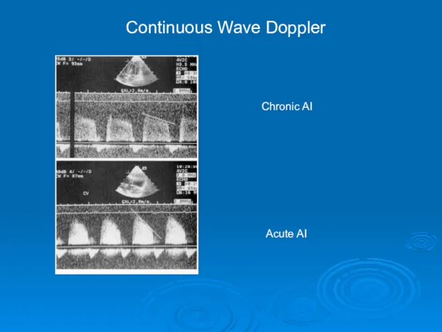 Chronic AI Acute AI Continuous Wave Doppler