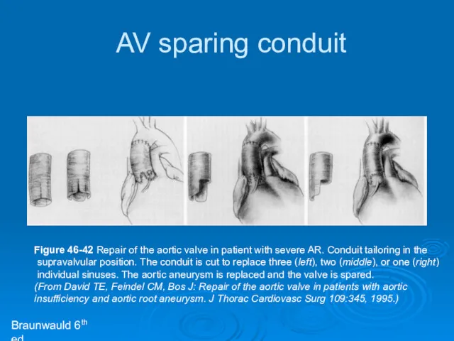 Figure 46-42 Repair of the aortic valve in patient with severe AR. Conduit