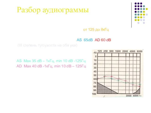 Разбор аудиограммы 1. Объем воспринимаемых частот -от 125 до 8кГц