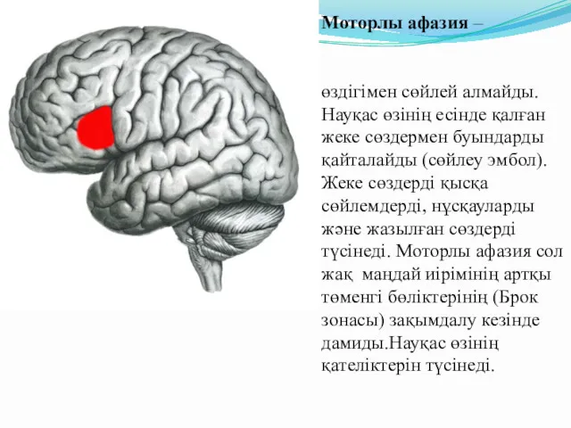 Моторлы афазия – өздігімен сөйлей алмайды. Науқас өзінің есінде қалған