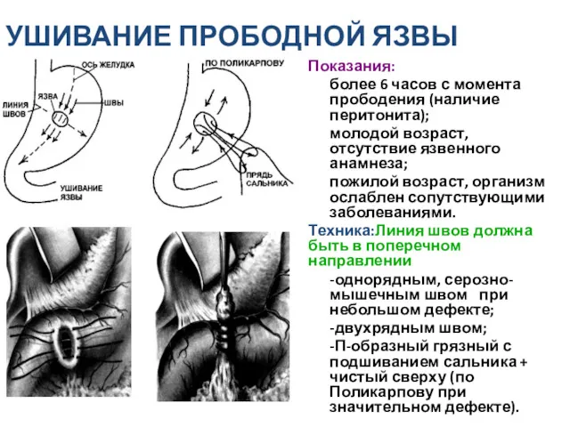 УШИВАНИЕ ПРОБОДНОЙ ЯЗВЫ Показания: более 6 часов с момента прободения