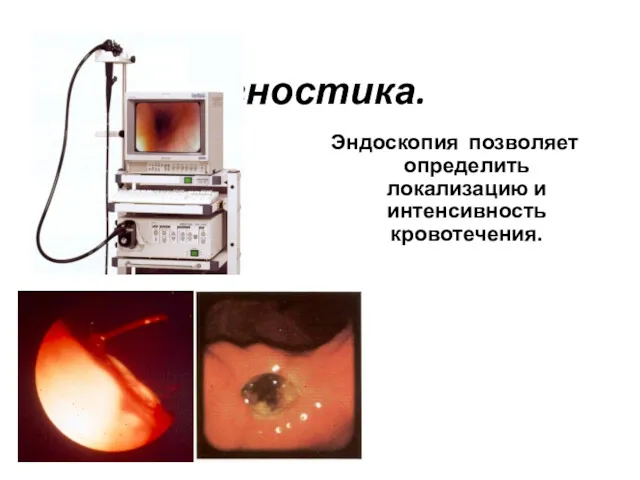 Диагностика. Эндоскопия позволяет определить локализацию и интенсивность кровотечения.