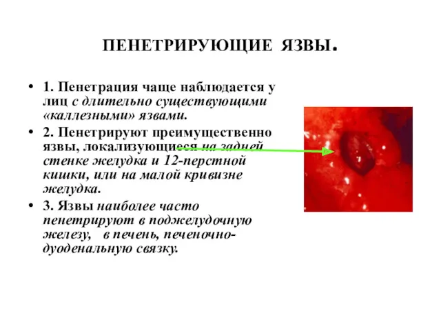 ПЕНЕТРИРУЮЩИЕ ЯЗВЫ. 1. Пенетрация чаще наблюдается у лиц с длительно