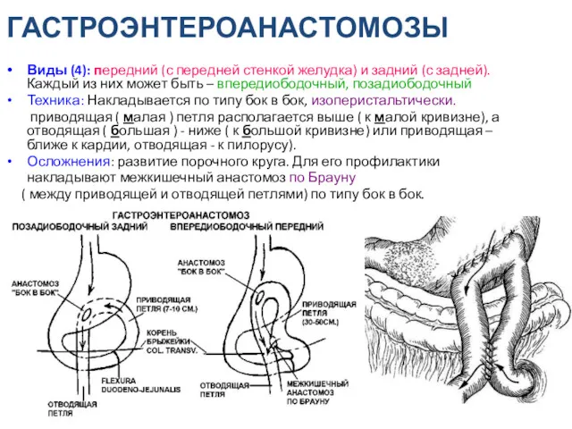 ГАСТРОЭНТЕРОАНАСТОМОЗЫ Виды (4): передний (с передней стенкой желудка) и задний