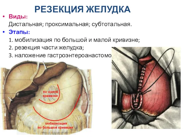 РЕЗЕКЦИЯ ЖЕЛУДКА Виды: Дистальная; проксимальная; субтотальная. Этапы: 1. мобилизация по