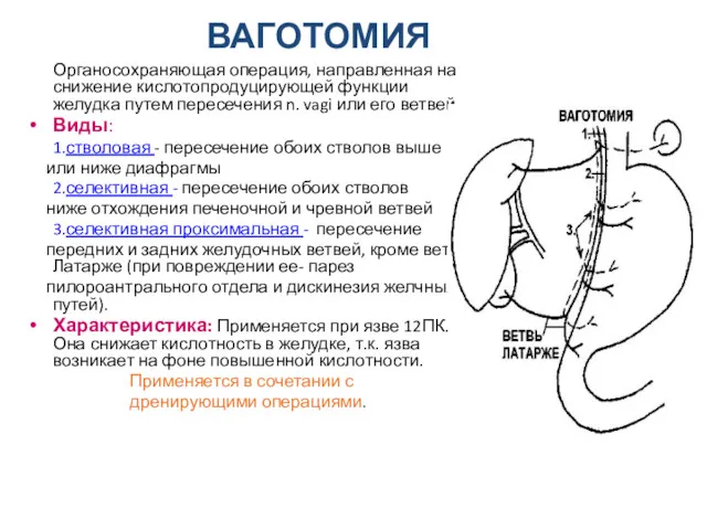 ВАГОТОМИЯ Органосохраняющая операция, направленная на снижение кислотопродуцирующей функции желудка путем