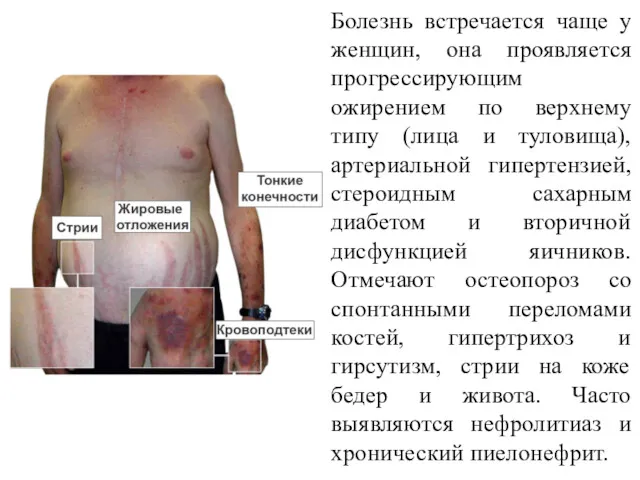 Болезнь встречается чаще у женщин, она проявляется прогрессирующим ожирением по