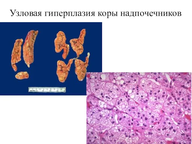 Узловая гиперплазия коры надпочечников