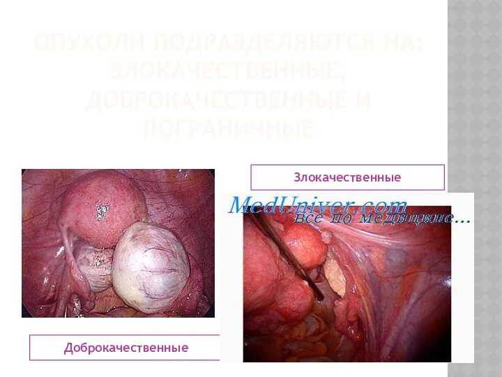 ОПУХОЛИ ПОДРАЗДЕЛЯЮТСЯ НА: ЗЛОКАЧЕСТВЕННЫЕ, ДОБРОКАЧЕСТВЕННЫЕ И ПОГРАНИЧНЫЕ Доброкачественные Злокачественные