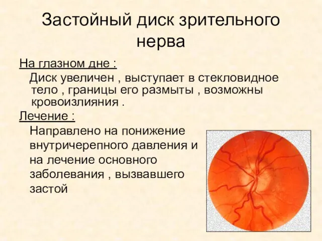Застойный диск зрительного нерва На глазном дне : Диск увеличен