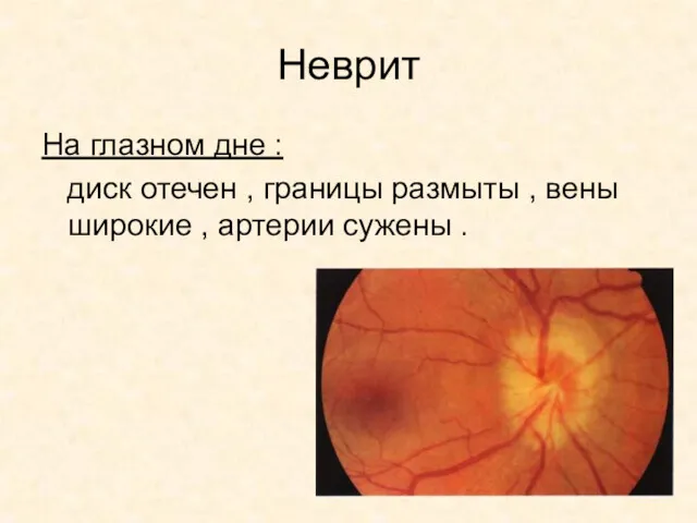 Неврит На глазном дне : диск отечен , границы размыты