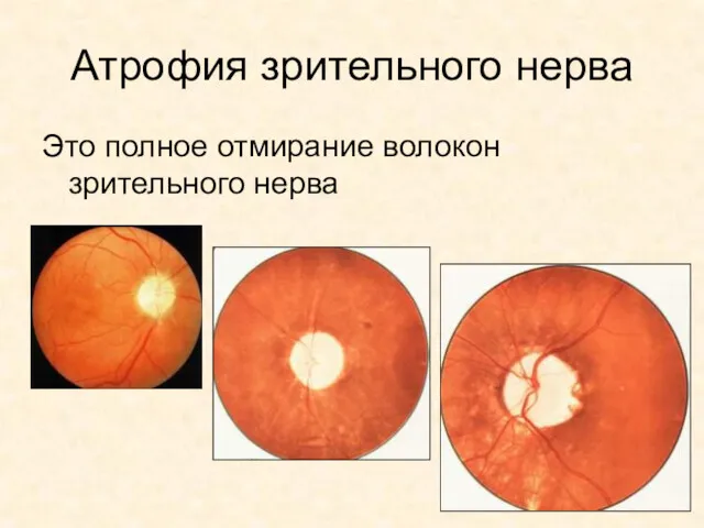 Атрофия зрительного нерва Это полное отмирание волокон зрительного нерва