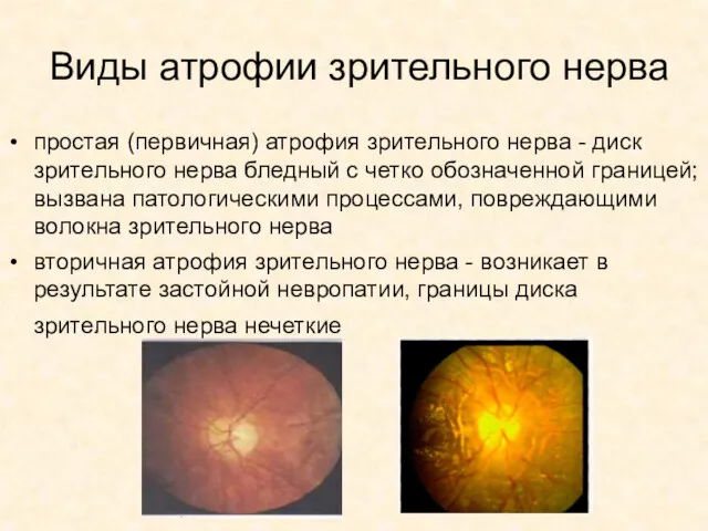 Виды атрофии зрительного нерва простая (первичная) атрофия зрительного нерва -