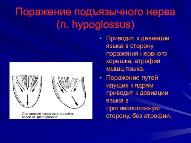 Поражение подъязычного нерва (n. hypoglossus) Приводит к девиации языка в