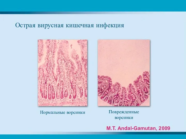 Нормальные ворсинки Поврежденные ворсинки Острая вирусная кишечная инфекция M.T. Andal-Gamutan, 2009