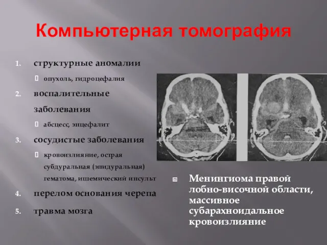 Компьютерная томография структурные аномалии опухоль, гидроцефалия воспалительные заболевания абсцесс, энцефалит
