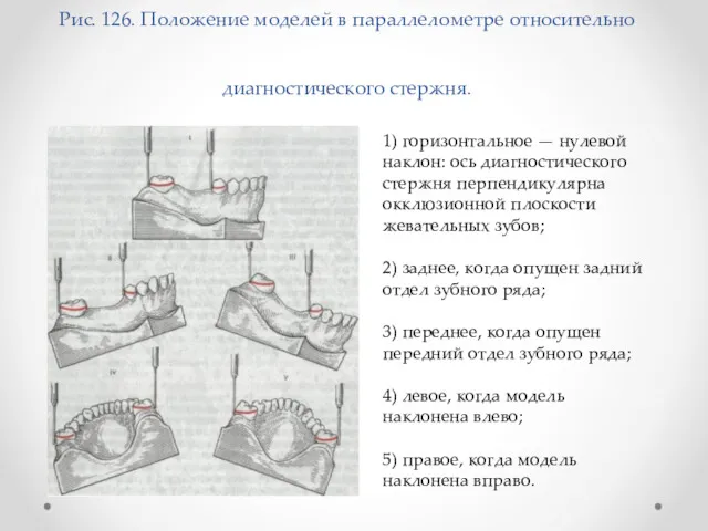 Рис. 126. Положение моделей в параллелометре относительно диагностического стержня. 1)