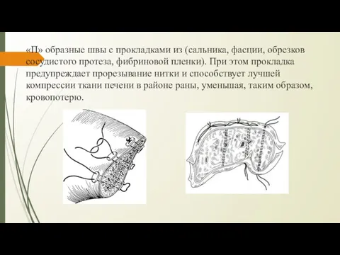 «П» образные швы с прокладками из (сальника, фасции, обрезков сосудистого