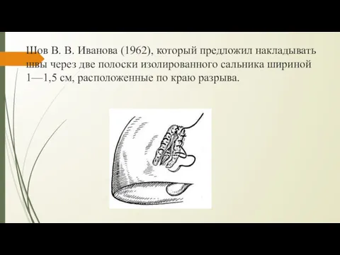 Шов В. В. Иванова (1962), который предложил накладывать швы через