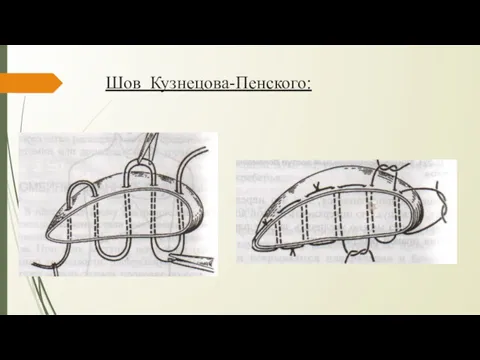 Шов Кузнецова-Пенского: