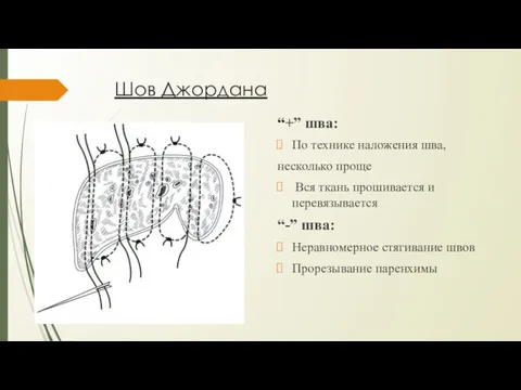 Шов Джордана “+” шва: По технике наложения шва, несколько проще