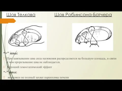 Шов Телкова Шов Робинсона-Батчера “+” шва: При завязывании шва сила