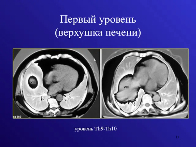 Первый уровень (верхушка печени) уровень Th9-Th10