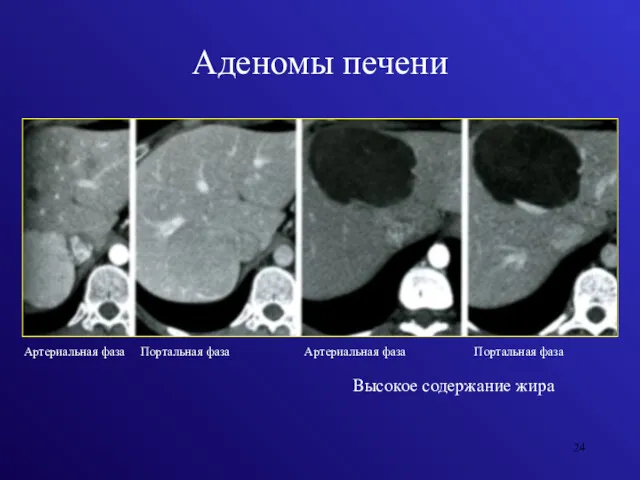 Аденомы печени Артериальная фаза Портальная фаза Артериальная фаза Портальная фаза Высокое содержание жира