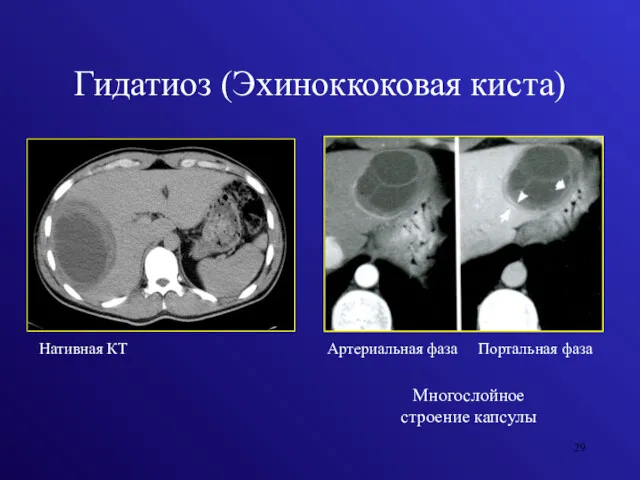 Гидатиоз (Эхиноккоковая киста) Нативная КТ Артериальная фаза Портальная фаза Многослойное строение капсулы