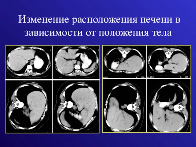 Изменение расположения печени в зависимости от положения тела